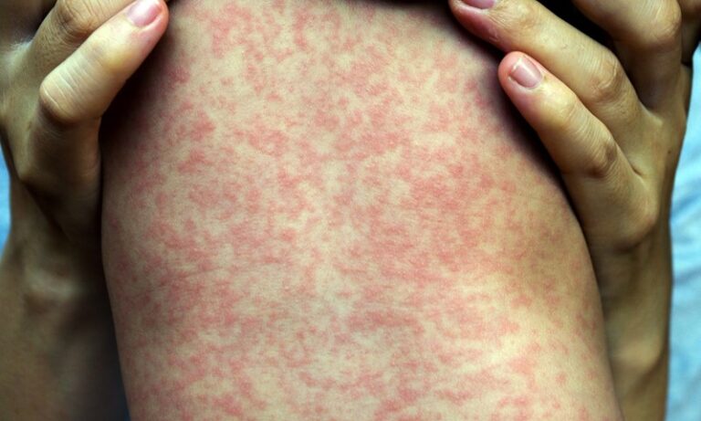 Measles Cases Surge Past 4,000 as Vaccine Hesitancy Fuels Outbreaks in South Africa and Abroad